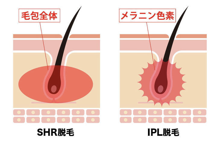 SHR脱毛・IPL脱毛